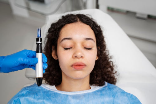 What is Micro-Needling and How Can It Benefit Your Skin?